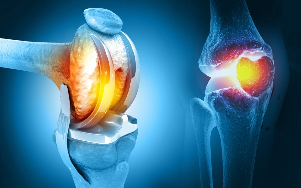 Joint Replacement Surgery Bangalore